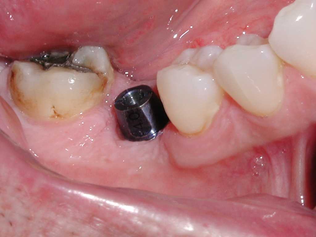 جراحی ایمپلنت